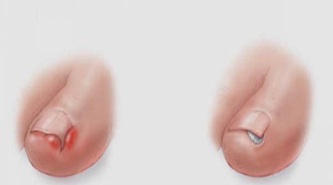 sfatul medicului afla tot ce trebuie sa stii despre tratarea unghiei incarnate