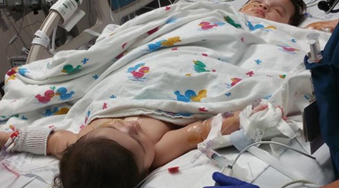 doua siameze au fost separate cu succes in texas