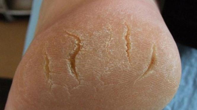 tratamente naturiste 7 solutii eficiente pentru calcaiele crapate