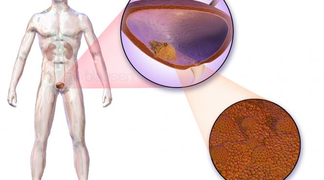 cancerul de vezica urinara o afectiune grava care poate trece neobservata