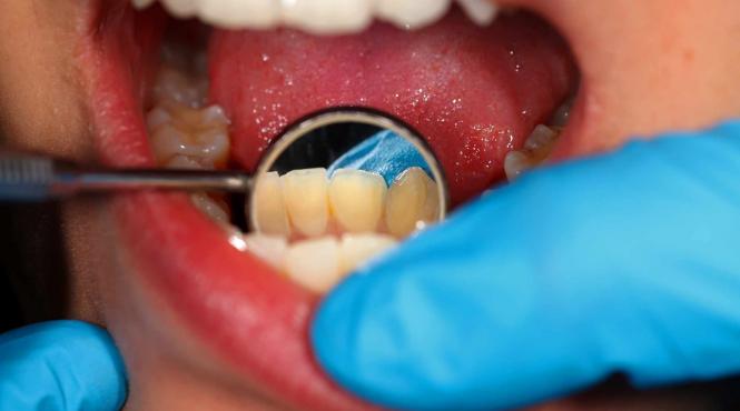 sfatul medicului cum recunosti si tratezi un abces dentar