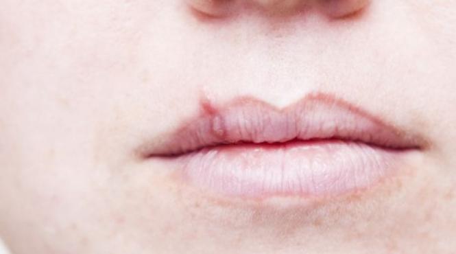 herpesul oral ce il activeaza si cum il tratam fara medicamente