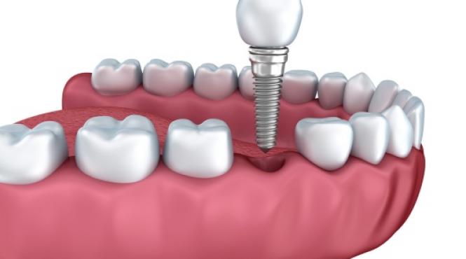 cele mai frecvente riscuri postoperatorii ale implantului dentar