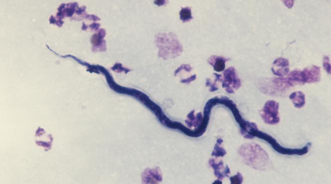 video filariozia loa loa o boala care daca nu este tratata iti iese prin ochi la propriu