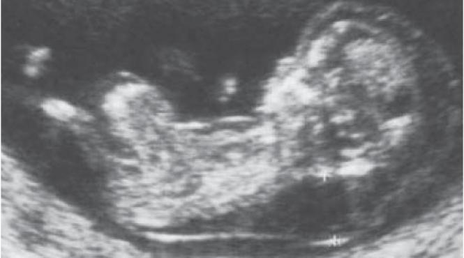 caz exceptional in franta un fetus si a salvat viata si pe cea a mamei in urma unei rupturi uterine