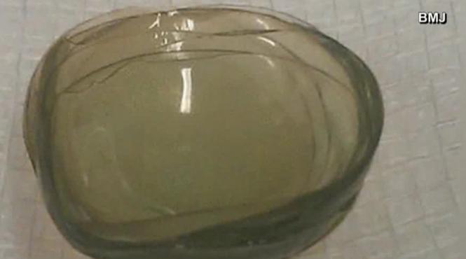 medicii din marea britanie au descoperit o femeie care purta 27 de lentile de contact la un ochi