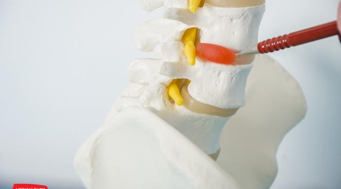 munca la calculator si hernia de disc cervical