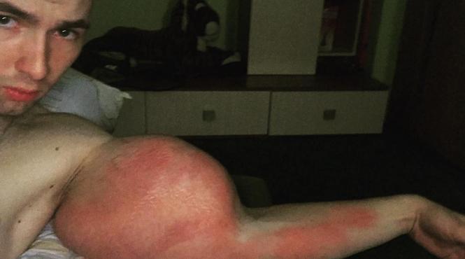 risca sa i fie amputate ambele brate dupa ce si a injectat 6 litri dintr un amestec facut in casa