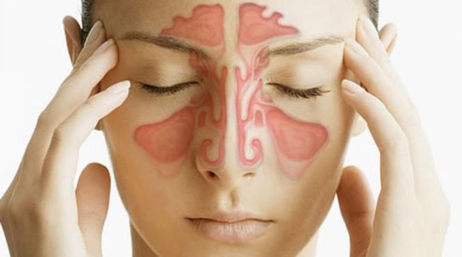 3 remedii naturale eficiente in combaterea sinuzitei