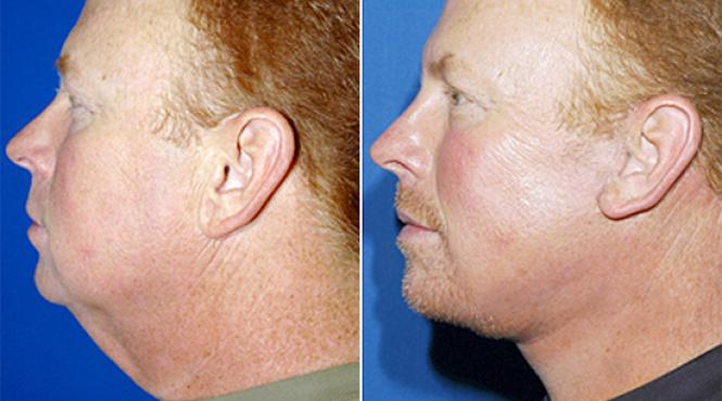 de ce apare gusa si cum poti scapa de ea