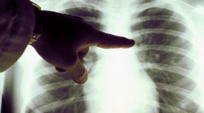 fibroza chistica ar putea fi tratata gratie unor celule nou descoperite