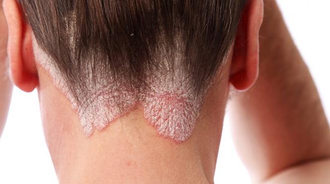 medicament minune pentru bolnavii de psoriazis