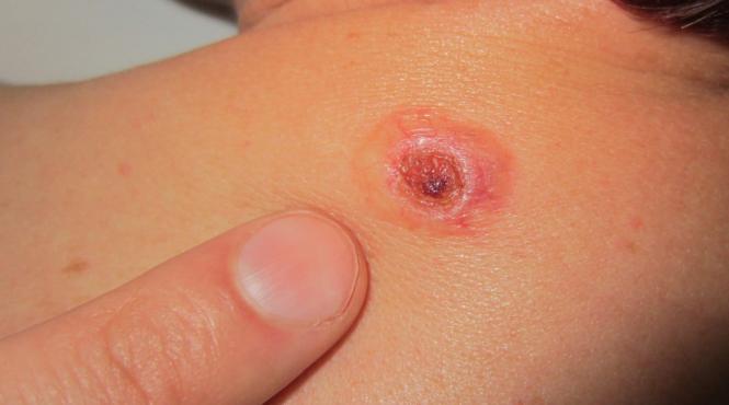 stii ca o alunita de pe pielea aparent sanatoasa poate sa ascunda un cancer de piele