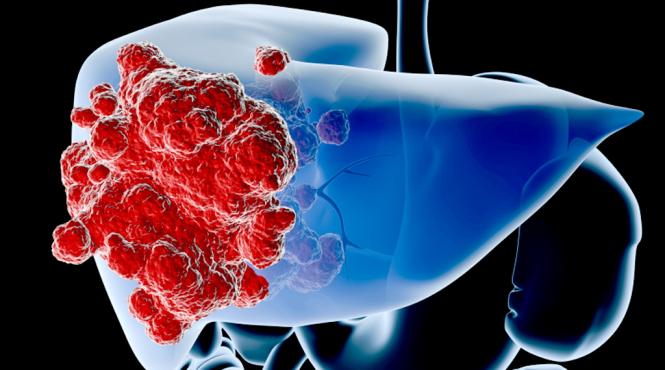 afectiunile hepatice de la diagnosticare la stadiul final