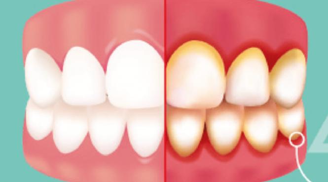 gingivita cea mai neglijata problema dentara cu consecinte grave cum o prevenim cum o tratam