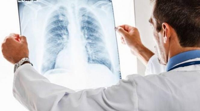 alarmant peste 10 000 de cazuri noi de cancer pulmonar depistate anual in romania