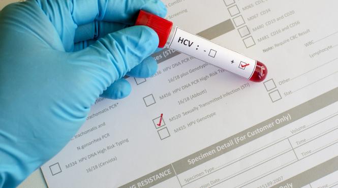 peste 15 000 de romani infectati cu hiv sida