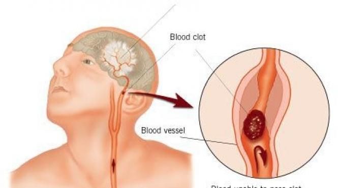 31 6 este riscul de accident vascular cereblar al regiunii din care facem parte