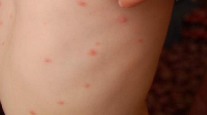 focare de varicela la o scoala din slatina si la o gradinita din bals