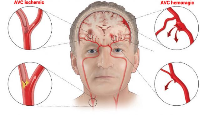 accident vascular cerebral avc simptome tratament si recuperare