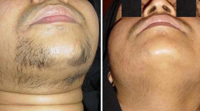 hirsutismul o problema medicala psihologica si de estetica a femeii 1