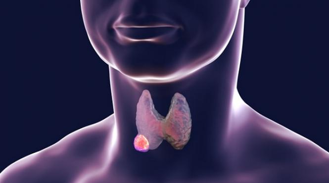 nodulii tiroidieni si cancerul ce trebuie sa stii 2