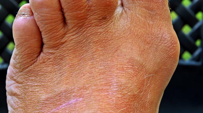 probleme si afectiuni ale picioarelor care pot conduce la complicatii grave