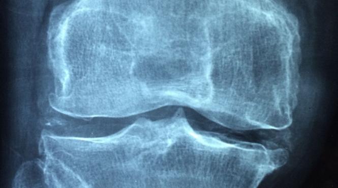 osteoporoza e o pierdere de substanta osoasa cu fragilizarea oaselor