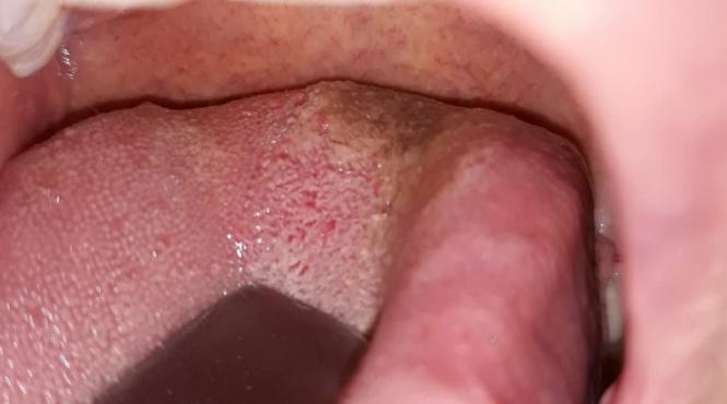 limba cu solzi un simptom necunoscut al covid