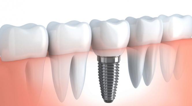 pregatirea pentru montarea unui implant dentar