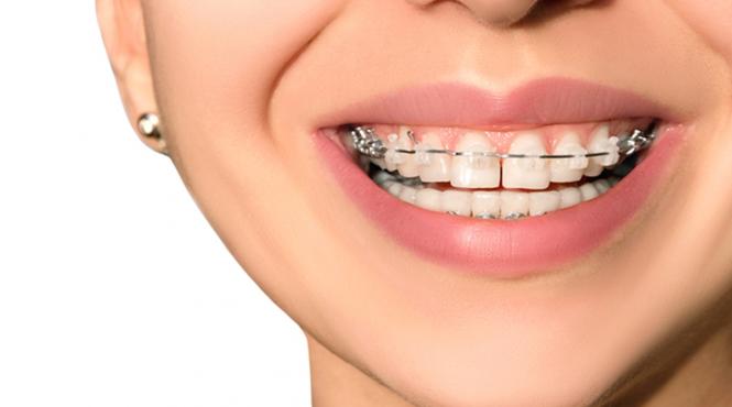 5 motive pentru care ar trebui sa iti pui aparat dentar