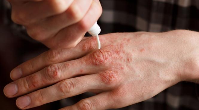 psoriazisul mai mult decat o boala de piele