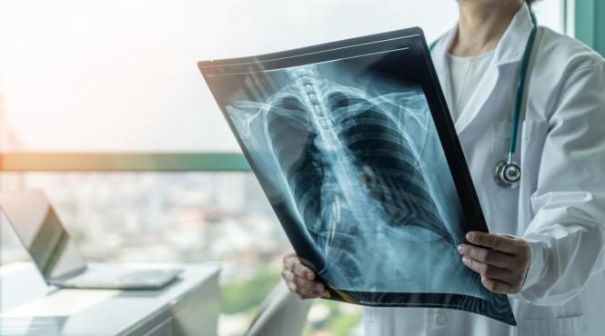 romania campioana la tbc cum vrea guvernul sa scape de tuberculoza pana in 2035