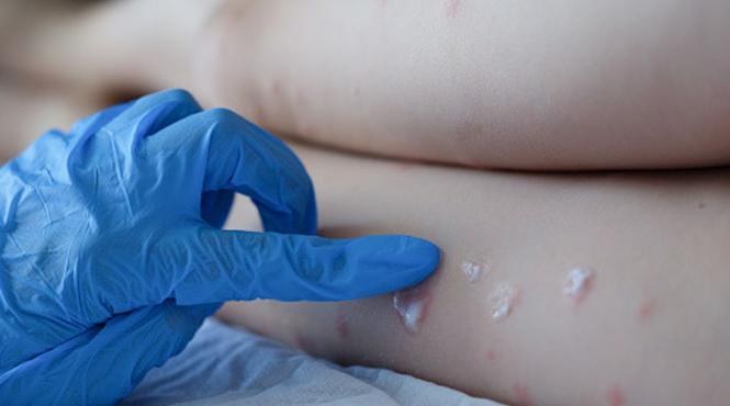 ue vrea sa achizitioneze vaccinuri si antivirale impotriva variolei maimutei