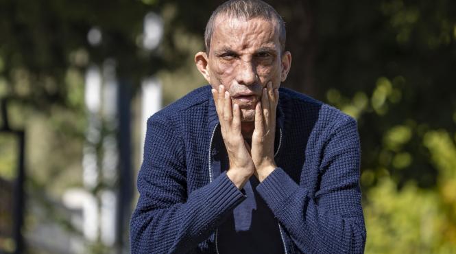 prima persoana care a facut un transplant de fata in turcia ugur acar surprins intr o sedinta foto