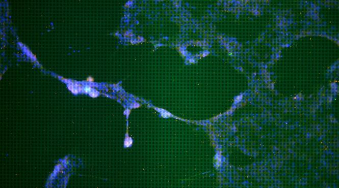 un nou tratament pentru alzheimer a fost autorizat in sua