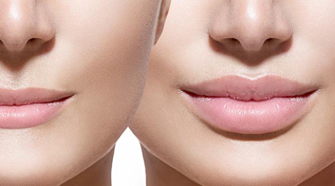 reconturare hidratare buze