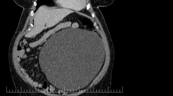 chist ovarian urias extirpat succes sibiu