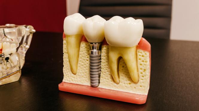 implantul dentar o optiune moderna si durabila pentru imbunatatirea sanatatii dentare