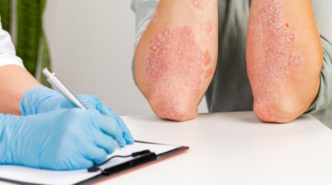 cele mai comune cauze ale psoriazisului ce trebuie sa stii