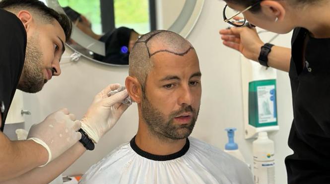 aspect natural si rezultate durabile implantul de par in romania