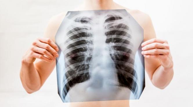 tuberculoza pacienti risc cancer