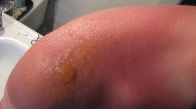 tratament arsuri solare simptome severe