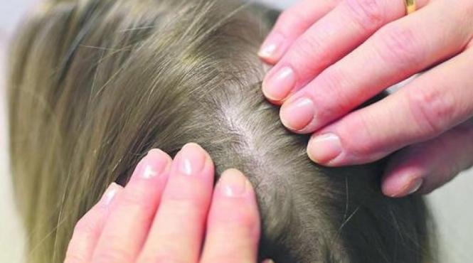 atentie la paduchii copilului preventie semne remedii naturale