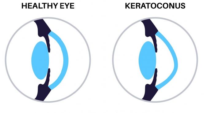 keratoconus cauze simptome si optiuni de tratament