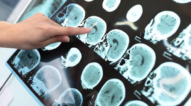 tehnologii de avangarda in neurostiinte oferite studentilor internationali de universitatea de medicina si farmacie iuliu hatieganu si institutul roneuro din cluj napoca