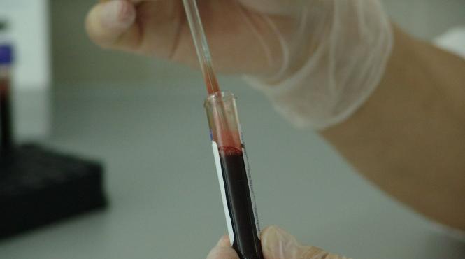 terapie nanoparticule carbon elimina placa artere