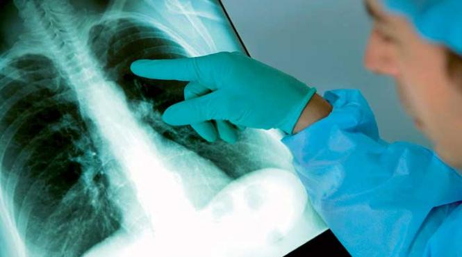 silicoza loveste spania boala pulmonara incurabila secol trecut revine europa