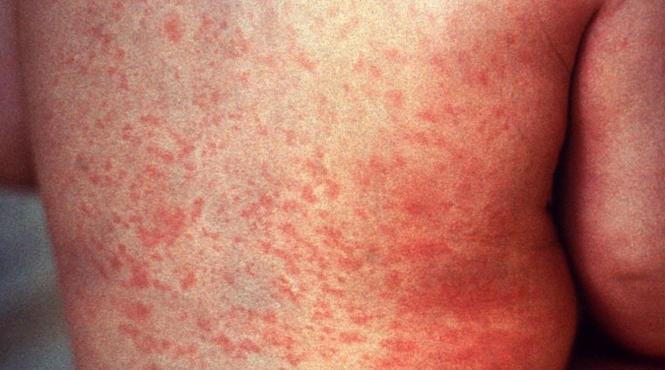 virusolog rujeola sistem imunitar creier