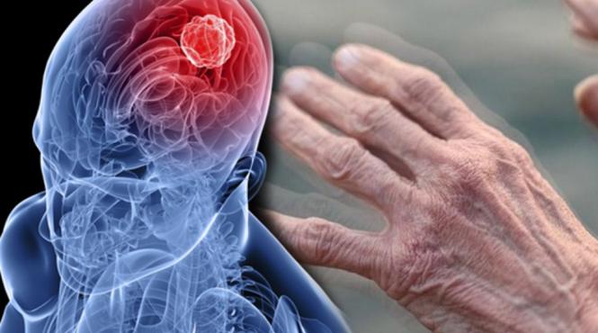 boala secol leac parkinson alzheimer